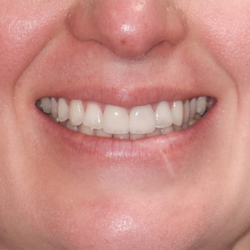Grandville Mi Dental Bridge Dentist