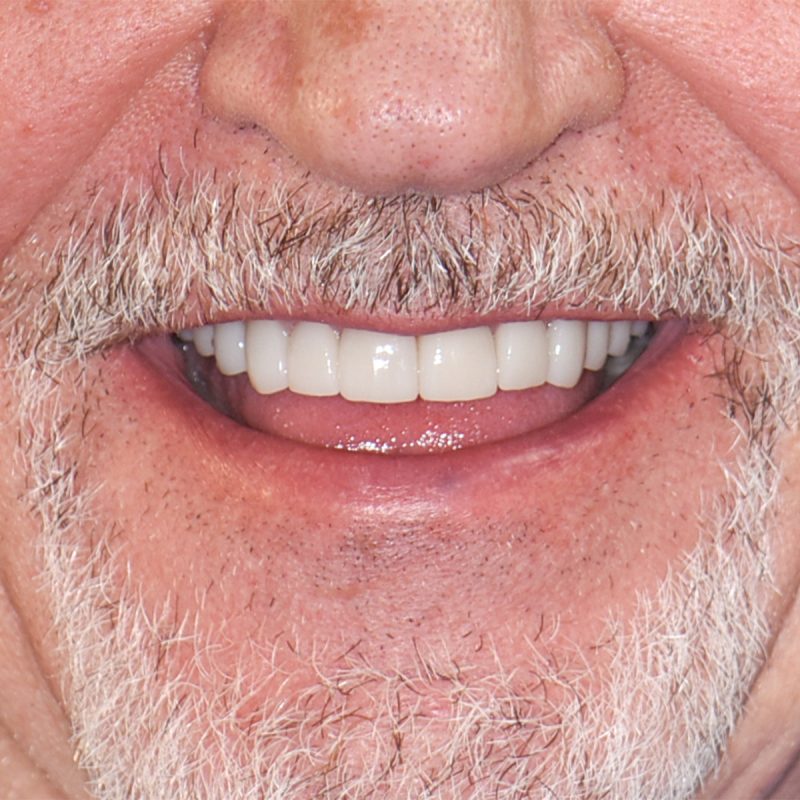 Grandville Mi Dental Implants