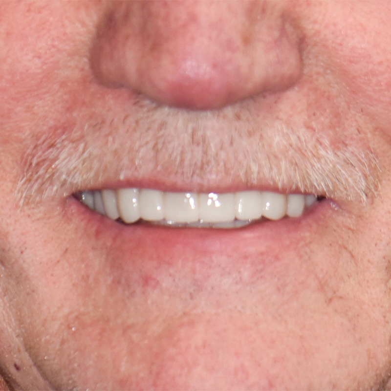 Grandville Dental Crowns Dentist