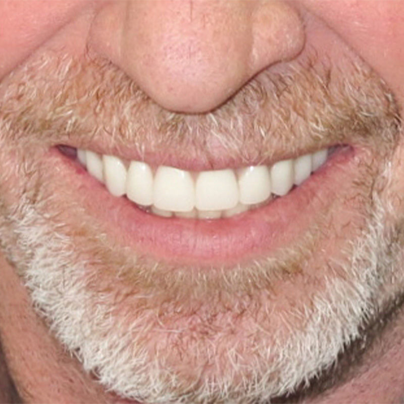 Implant Supported Dentures Dentist In Grandville Mi