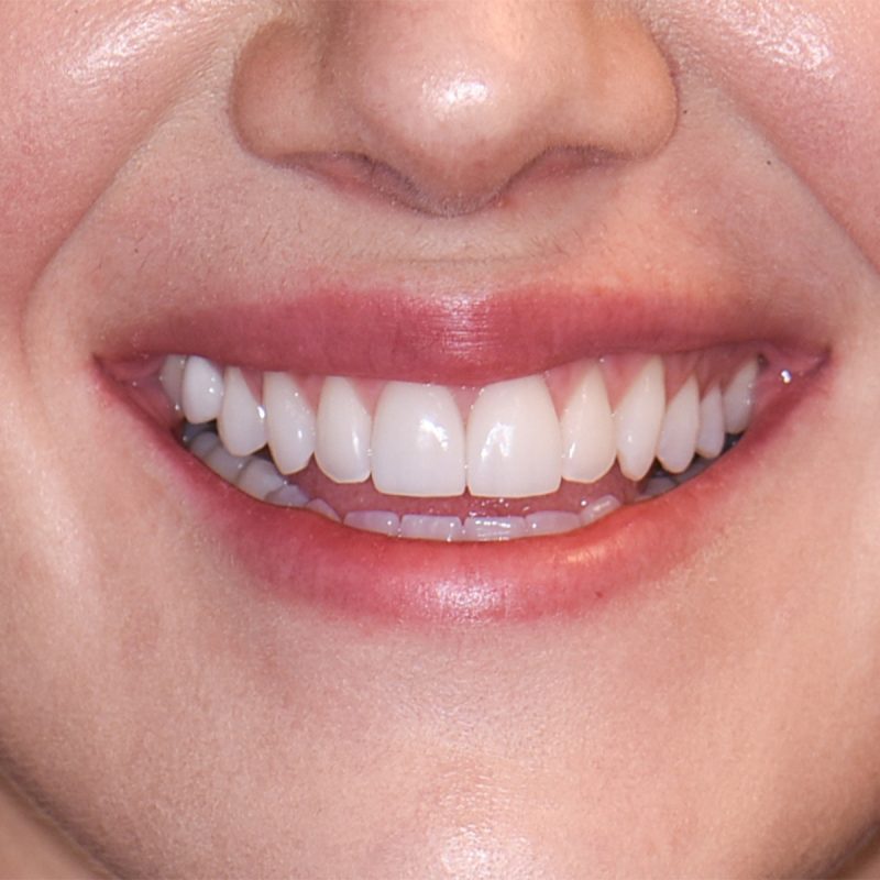 Porcelain Veneers Dentist In Grandville Mi