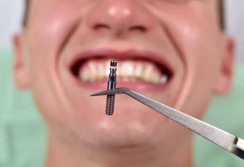 Dental implant in tweezers Dental implant in tweezers