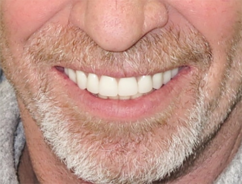 After Image: Dentures - front