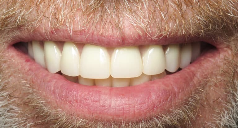After Image: Dentures - front