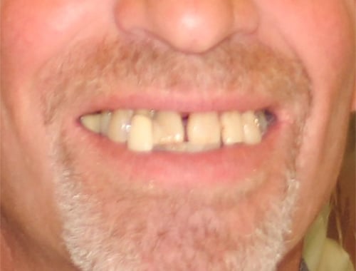 Before Image: Dentures - front