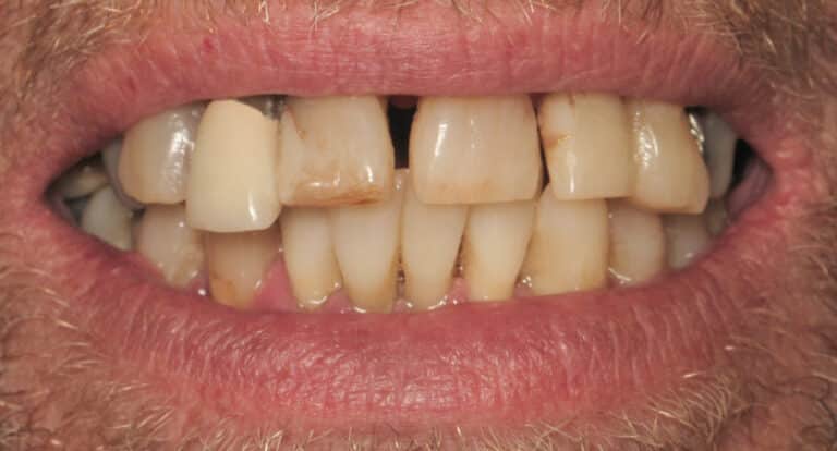 Before Image: Dentures - front