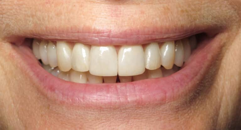 After Image: Porcelain Veneers - front