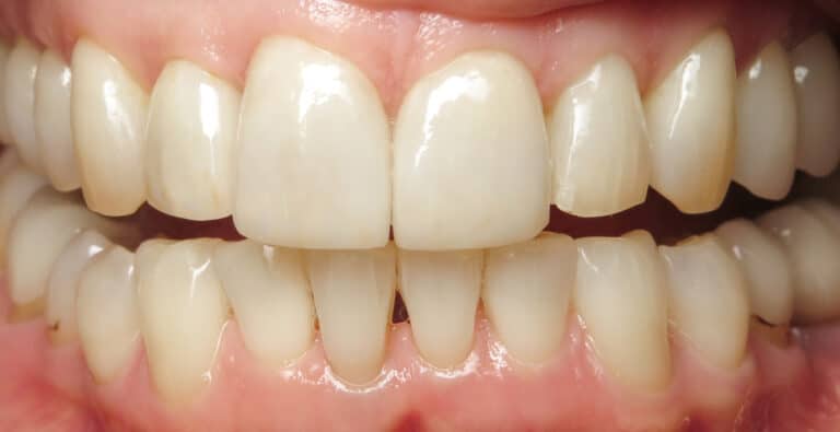 After Image: Porcelain Veneers -