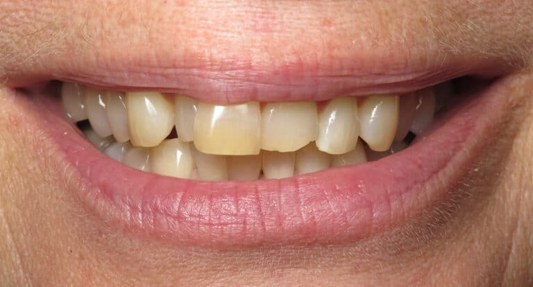 Before Image: Porcelain Veneers - front