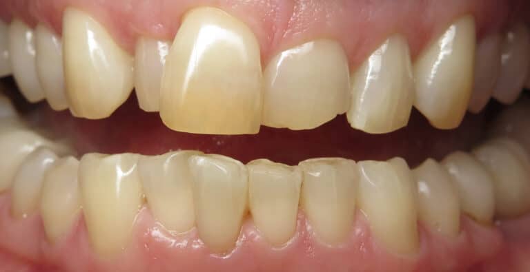 Before Image: Porcelain Veneers -