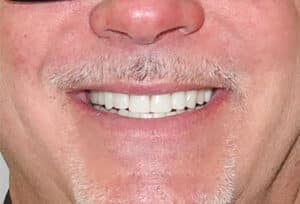 After Image: Composite Resin Bonding