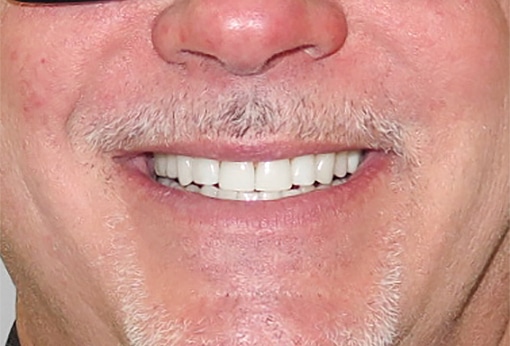 After Image: Composite Resin Bonding - front