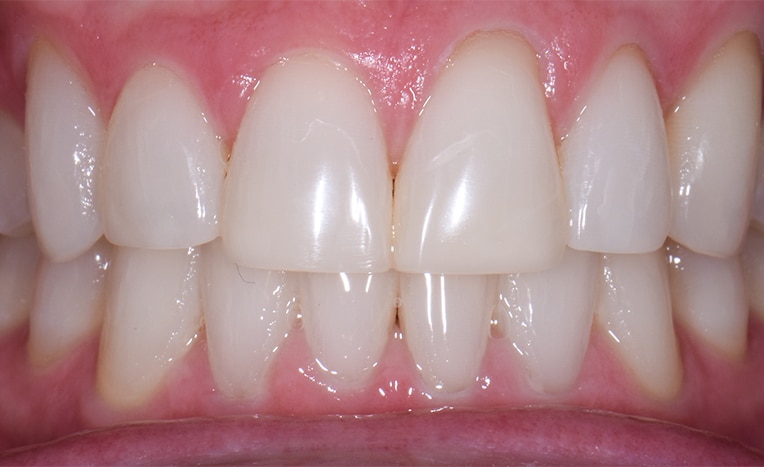 After Image: Composite Resin Bonding - 