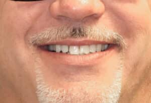 Before Image: Composite Resin Bonding