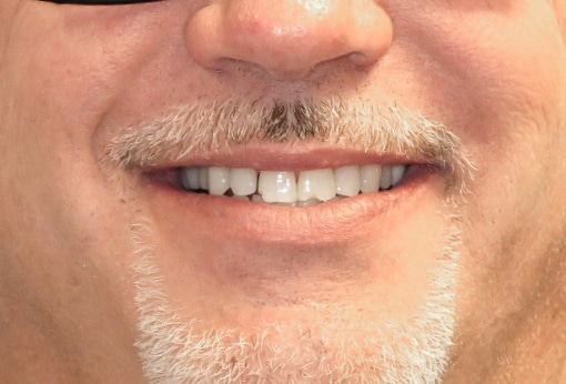 Before Image: Composite Resin Bonding - front
