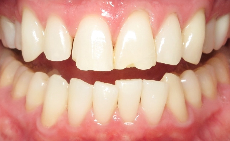 Before Image: Composite Resin Bonding - 
