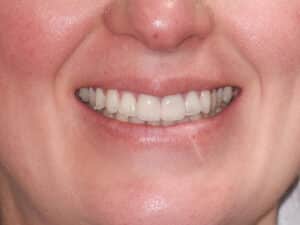 After Image: Porcelain Crowns and Bridges