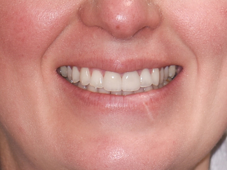 After Image: Porcelain Crowns and Bridges - front