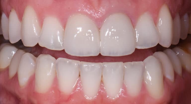 After Image: Porcelain Crowns and Bridges - front