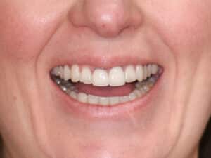 Before Image: Porcelain Crowns and Bridges