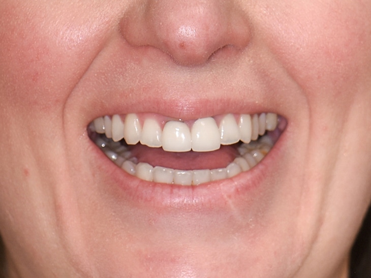 Before Image: Porcelain Crowns and Bridges - front