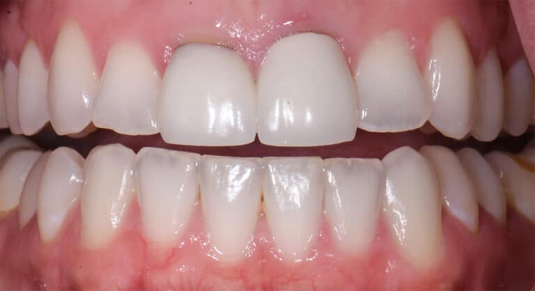 Before Image: Porcelain Crowns and Bridges - front