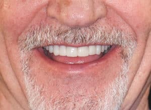 After Image: Porcelain Crowns and Bridges