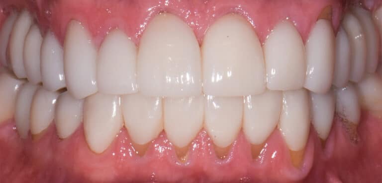 After Image: Porcelain Crowns and Bridges - front