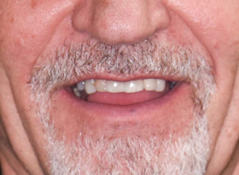 Before Image: Porcelain Crowns and Bridges - front