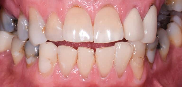 Before Image: Porcelain Crowns and Bridges - front