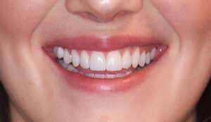 After Image: Porcelain Veneers