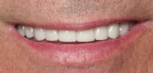After Image: Porcelain Crowns and Bridges