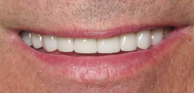 After Image: Porcelain Crowns and Bridges - front