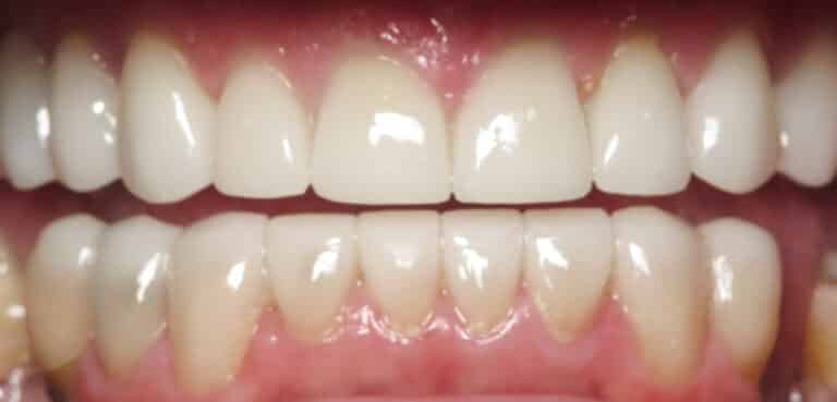 After Image: Porcelain Crowns and Bridges - front