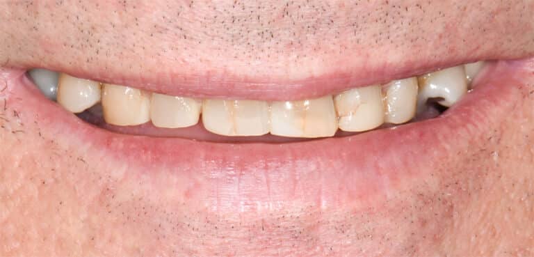 Before Image: Porcelain Crowns and Bridges - front