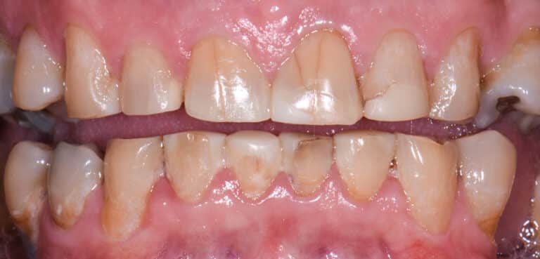 Before Image: Porcelain Crowns and Bridges - front
