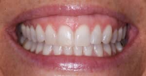 After Image: Composite Resin Bonding