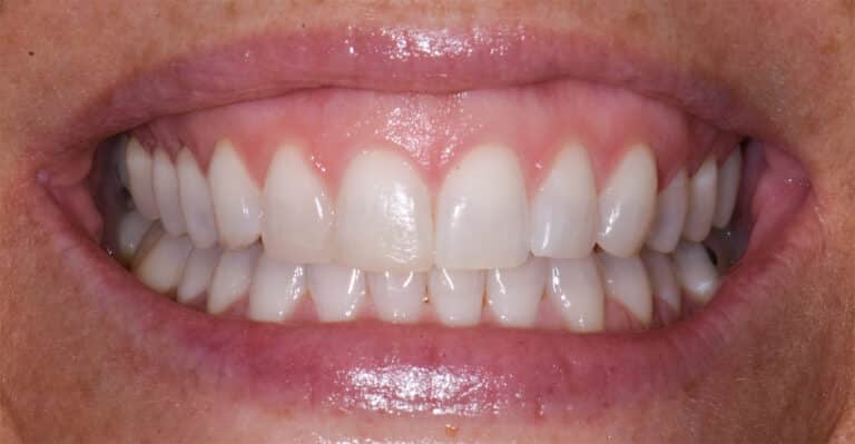 After Image: Composite Resin Bonding - front