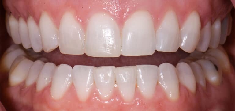 After Image: Composite Resin Bonding - 