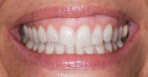 Before Image: Composite Resin Bonding