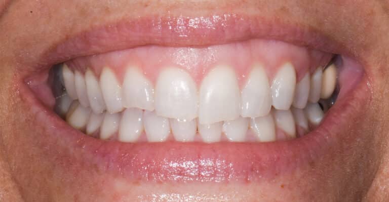 Before Image: Composite Resin Bonding - front