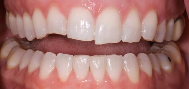 Before Image: Composite Resin Bonding - 