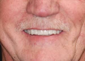 After Image: Porcelain Crowns and Bridges