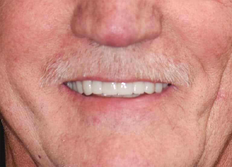 After Image: Porcelain Crowns and Bridges - front