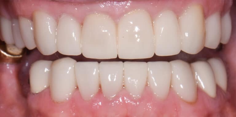 After Image: Porcelain Crowns and Bridges -