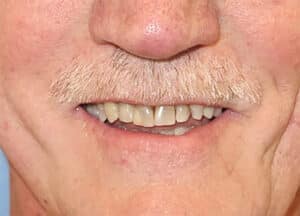 Before Image: Porcelain Crowns and Bridges