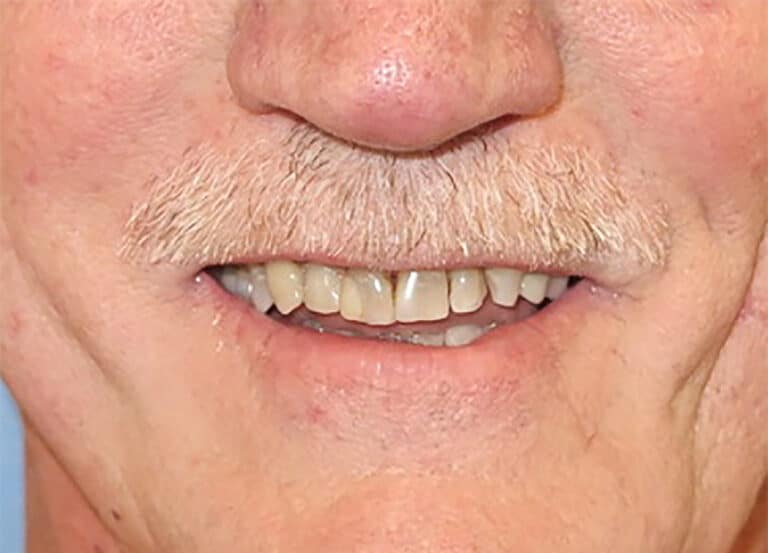 Before Image: Porcelain Crowns and Bridges - front
