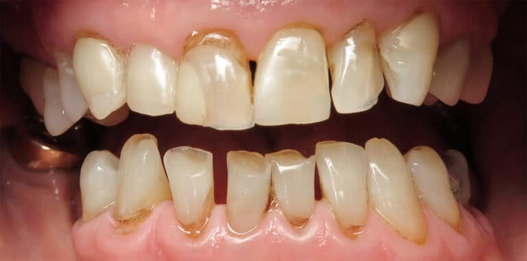 Before Image: Porcelain Crowns and Bridges -