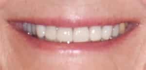 After Image: Porcelain Crowns and Bridges
