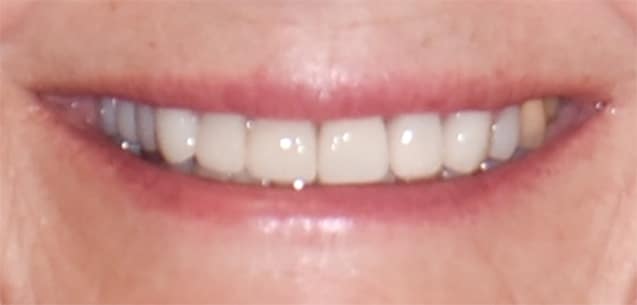 After Image: Porcelain Crowns and Bridges - front